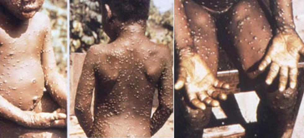 Confused Texans Ask, What The Heck is Monkeypox? How did it Get Here?