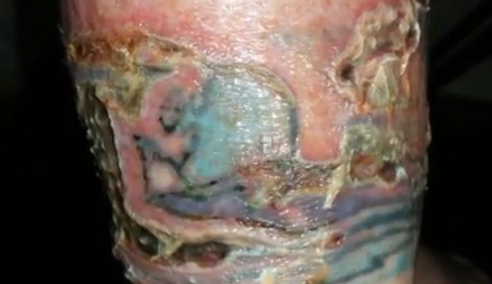 Copperas Cove Woman Suffers 3rd Degree Burns From Laser Hair Removal