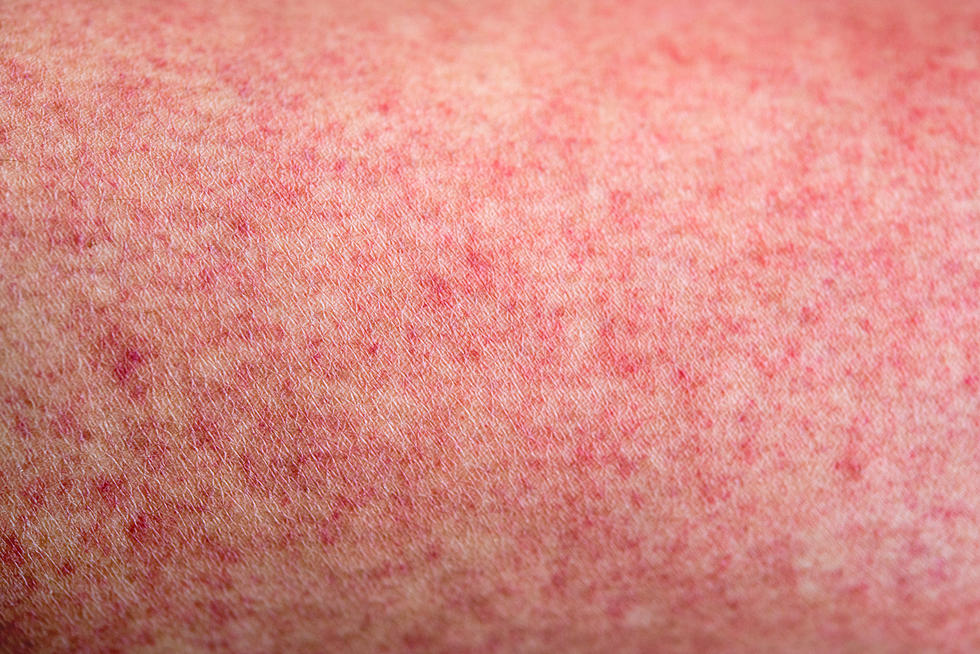 Measles Case Confirmed in Dartmouth