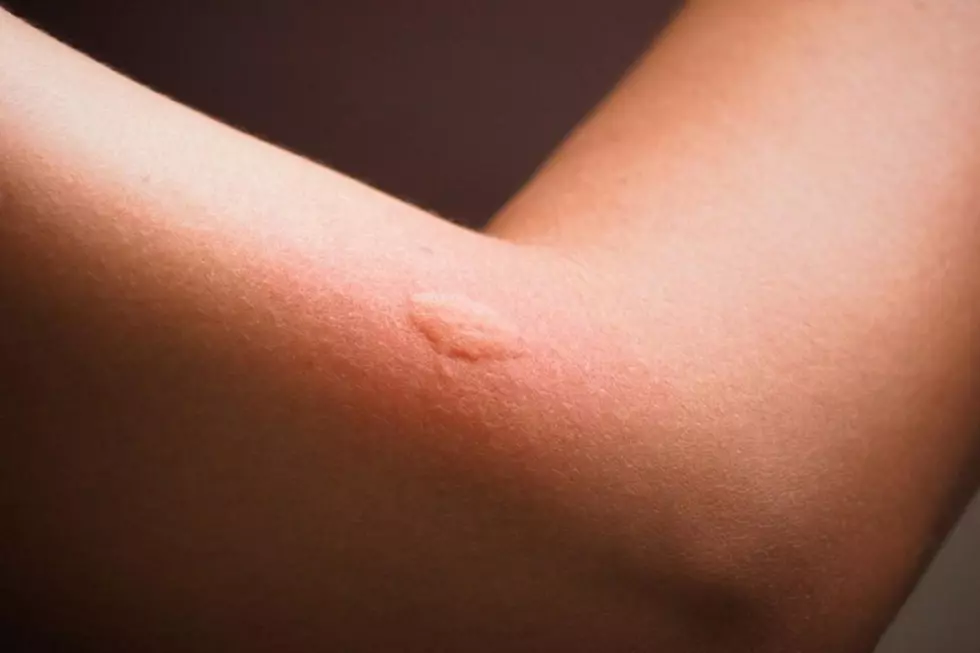 Home Remedies to Treat a Mosquito Bite