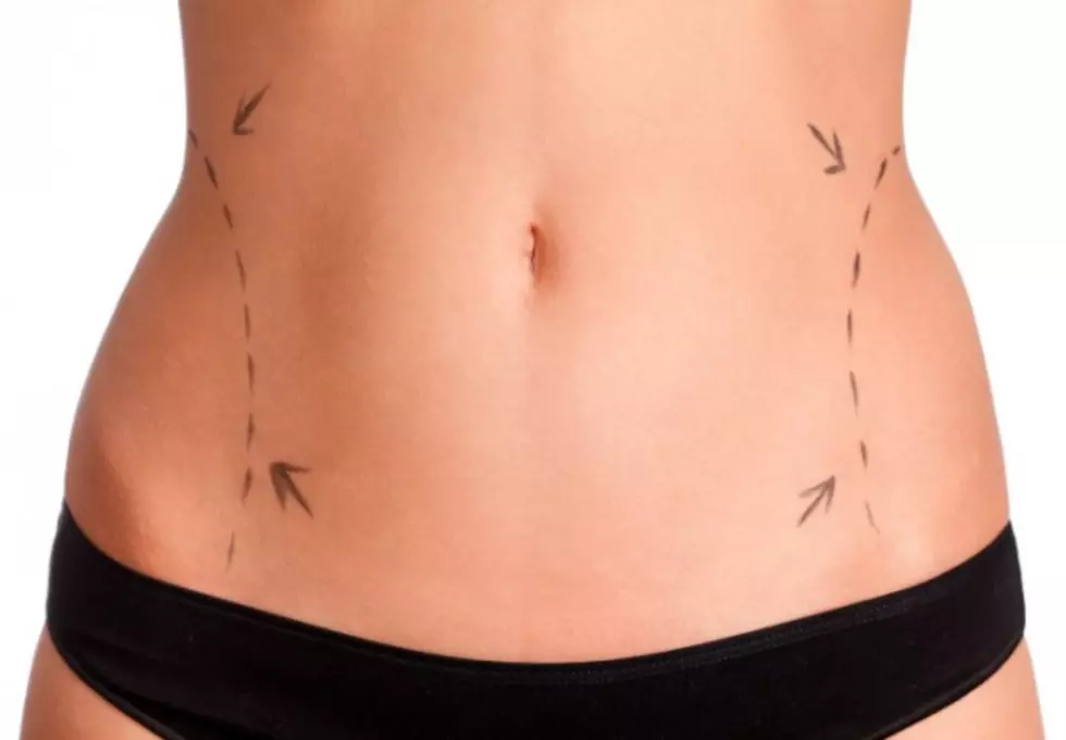 Having Trouble Losing Weight? Have You Considered Liposuction?