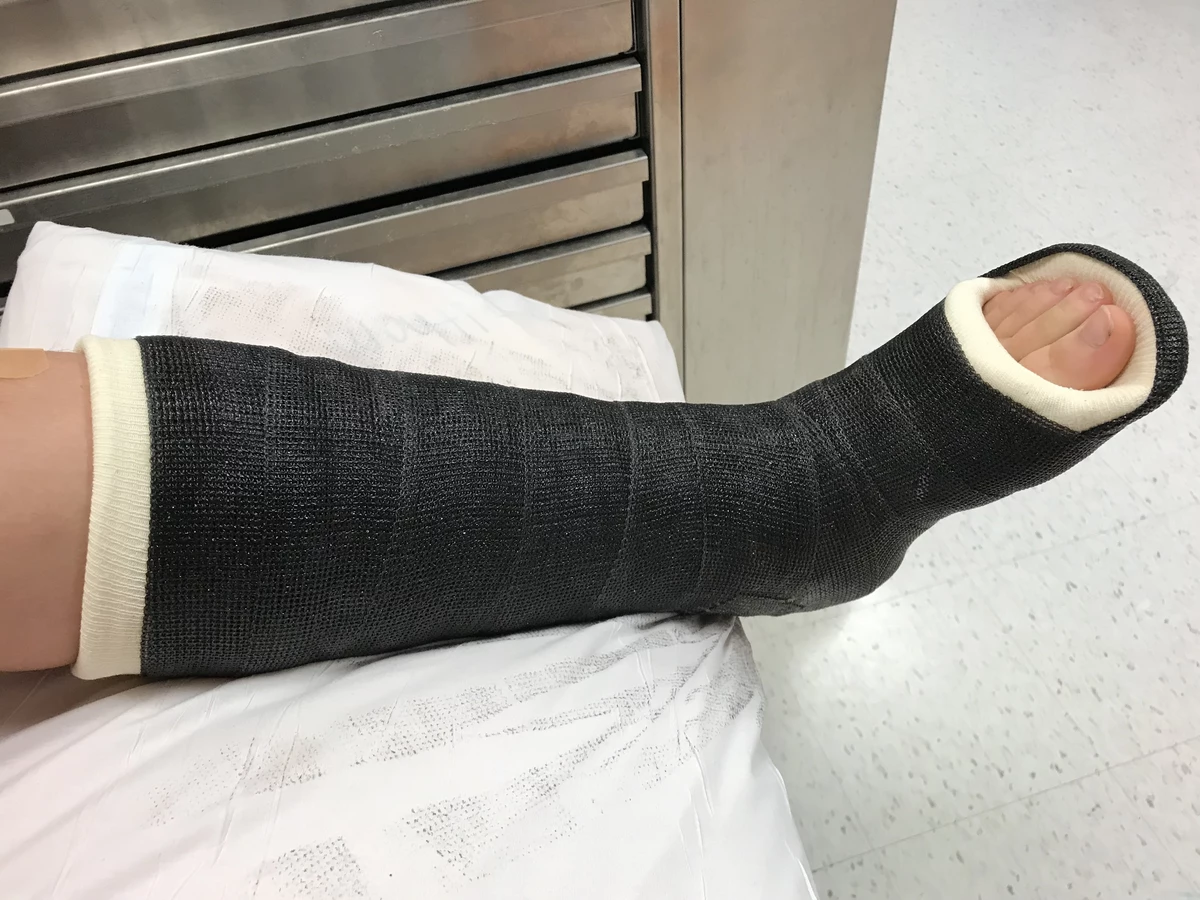 Ever Wonder How Hospitals Remove A Cast From A Leg Video