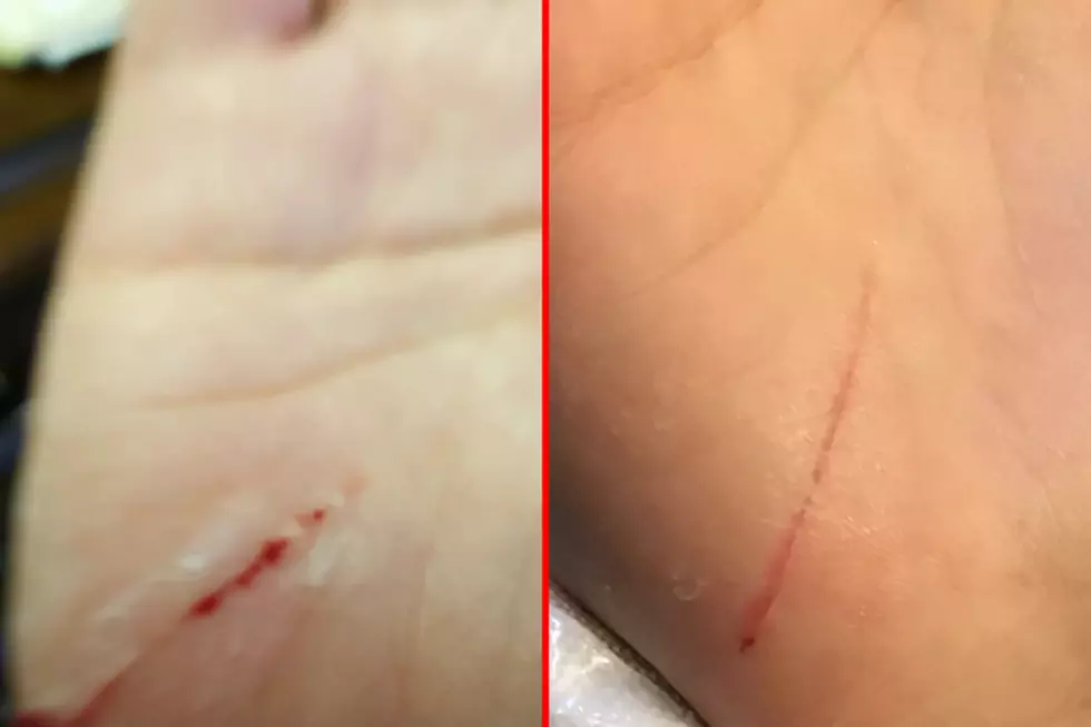 Have You Ever Superglued a Cut? (PHOTOS)