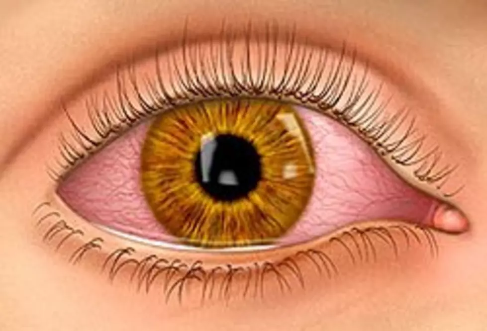 Pink Eye: Potential Symptom of COVID-19