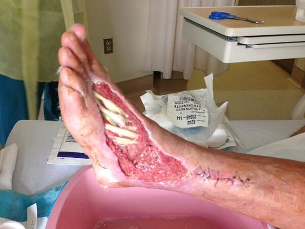 Alabama Man Nearly Loses Foot Due To Snake Bite