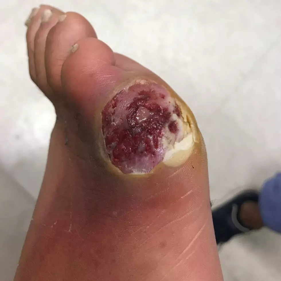 Diabetic Man Shares Photo of COVID-19’s Affect on Skin