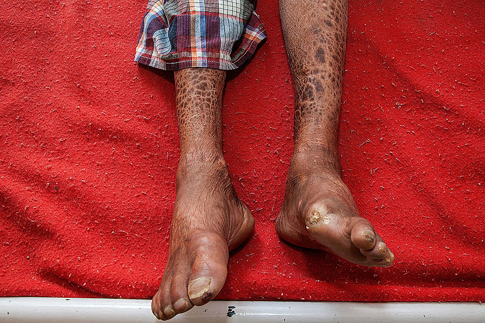 What Alabamians Need to Know about Florida’s Leprosy Scare