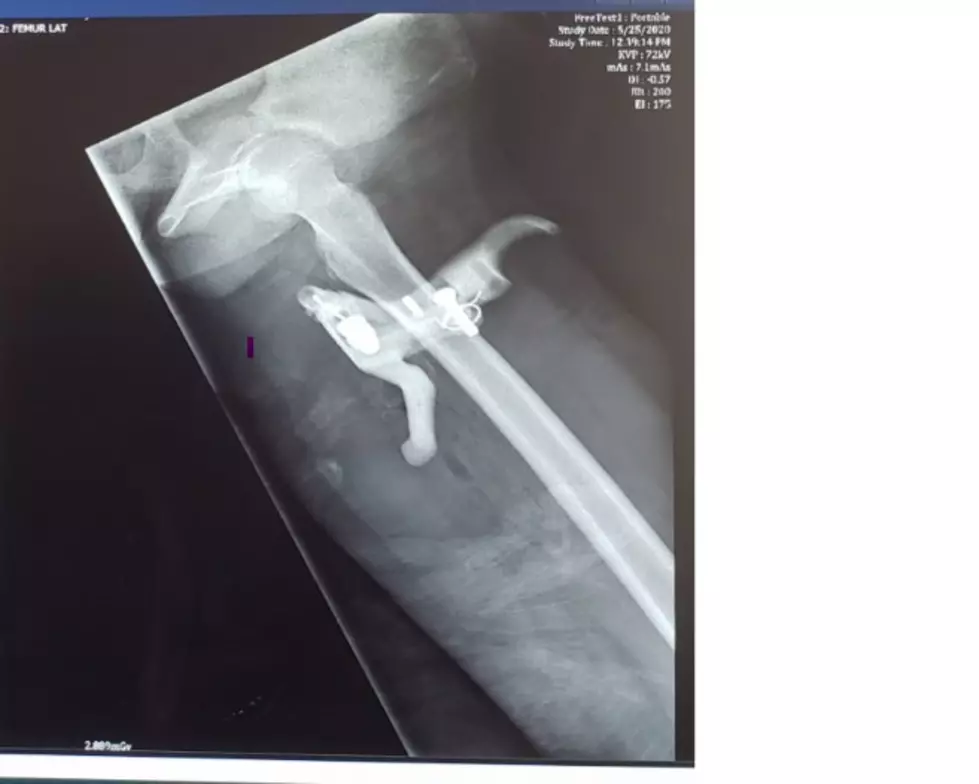 Bangor Teen ‘Brakes’ His Leg In A Mountain Bike Accident