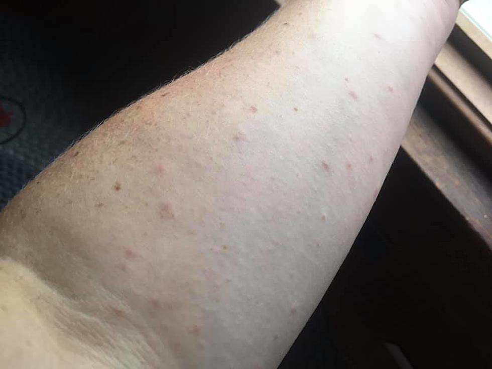 Got a Browntail Moth Rash? This Might Help
