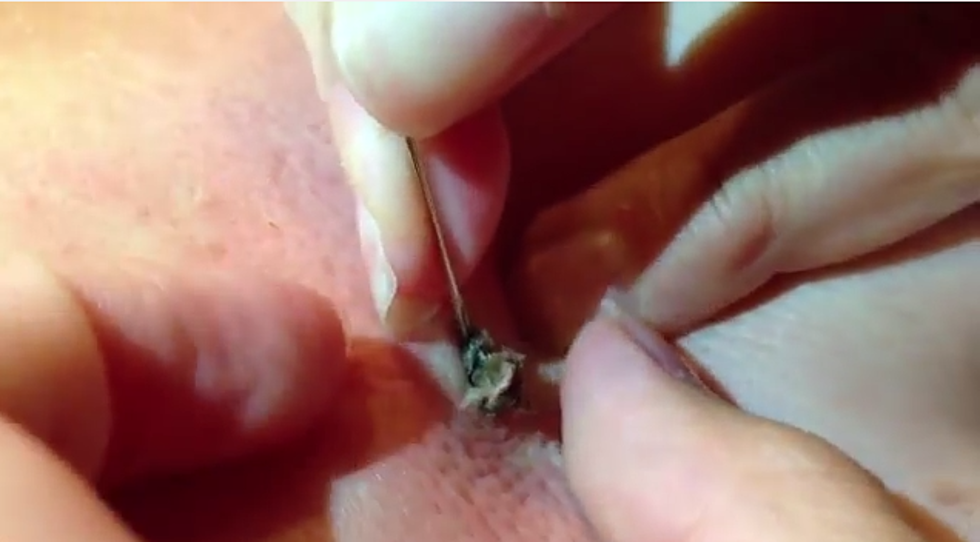 25-Year-Old Blackhead Is Finally Removed