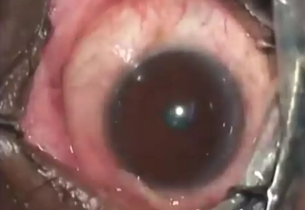 Doctors Remove Grotesque 19 Centimeter Long Eye Worm