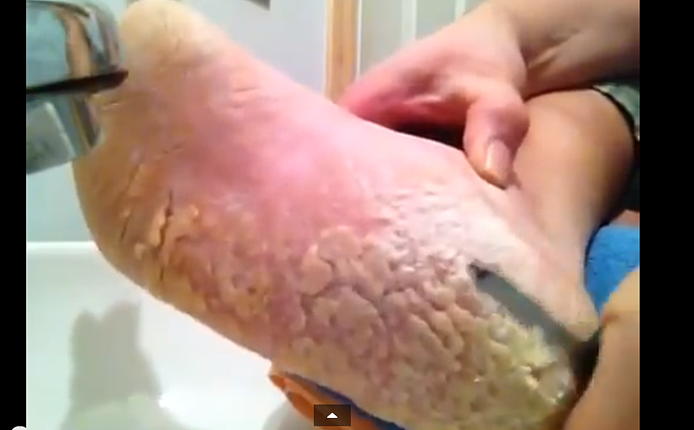 Man Scraping Reptile-Like Skin Off His Foot Will Leave You Gagging