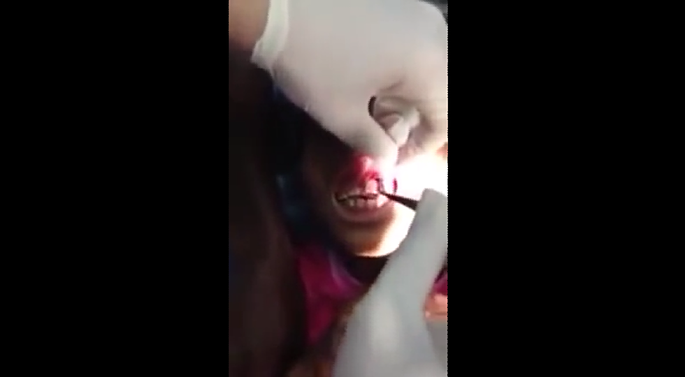 Little Girl Has Maggots Removed From Her Gums [NSFW]