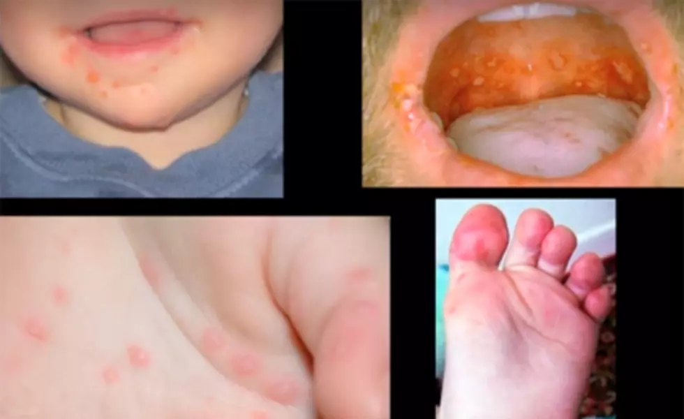 Hand Foot and Mouth Disease Hits Area School, Oh and Lice Too