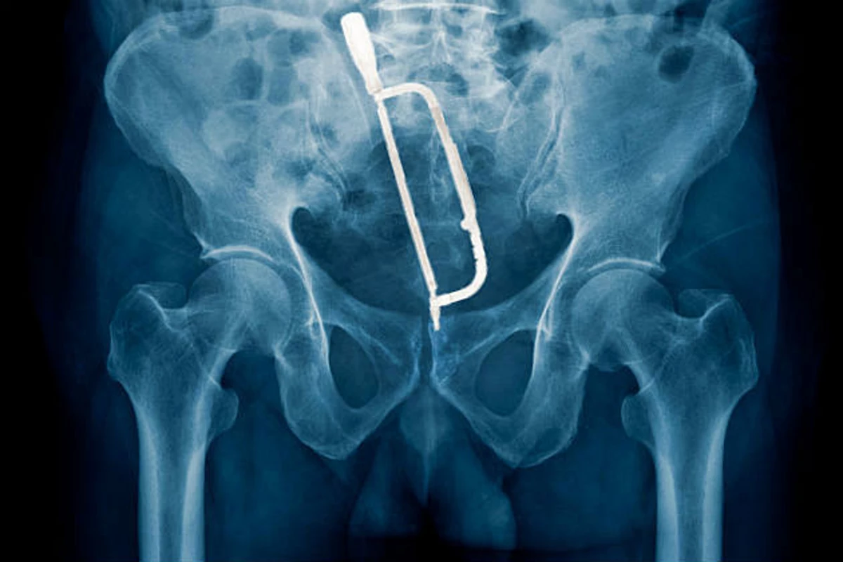 Остеопороз таза рентген
