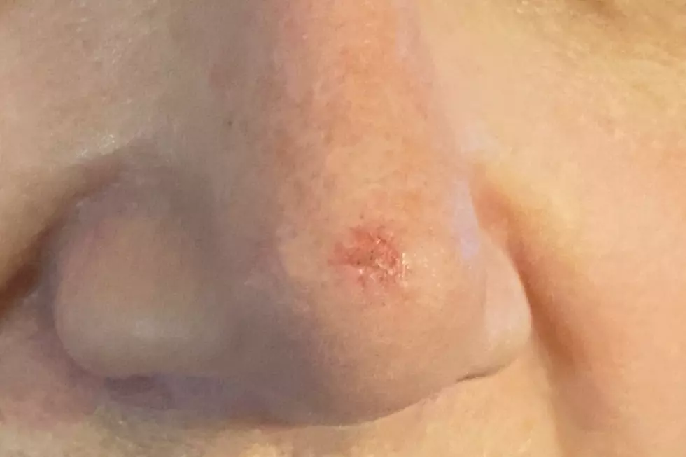 Should I Be Concerned About This Red Spot Being Skin Cancer?