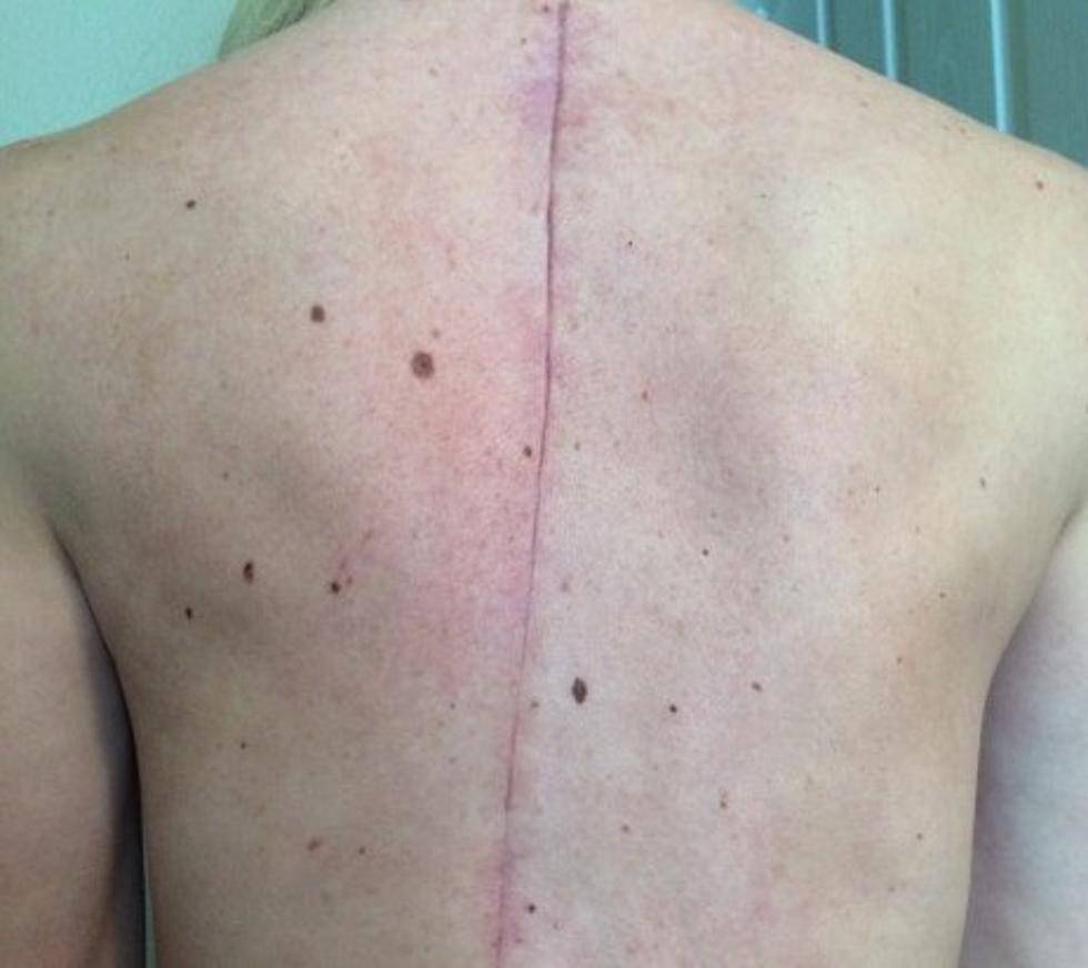 My Personal Battle with Scoliosis