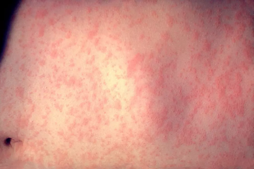 Measles Outbreak Could Be Headed to Idaho