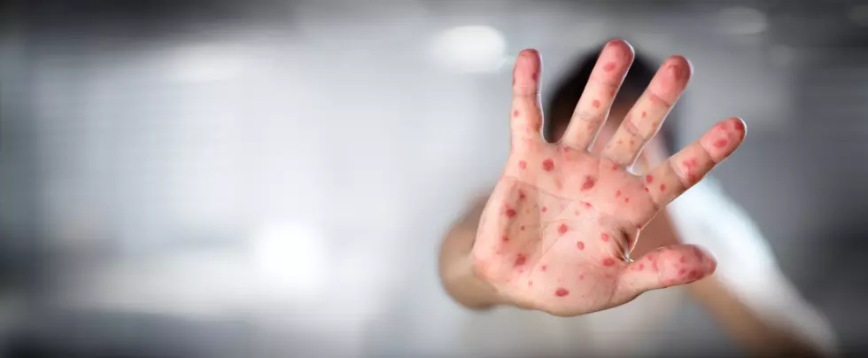 Almost 4,000 Idaho Kids Are Not Immunized For Measles