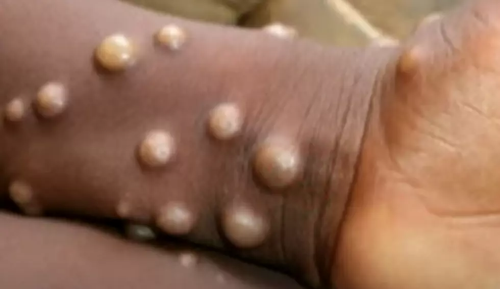 Two Reported Monkeypox Cases Reported Near Idaho