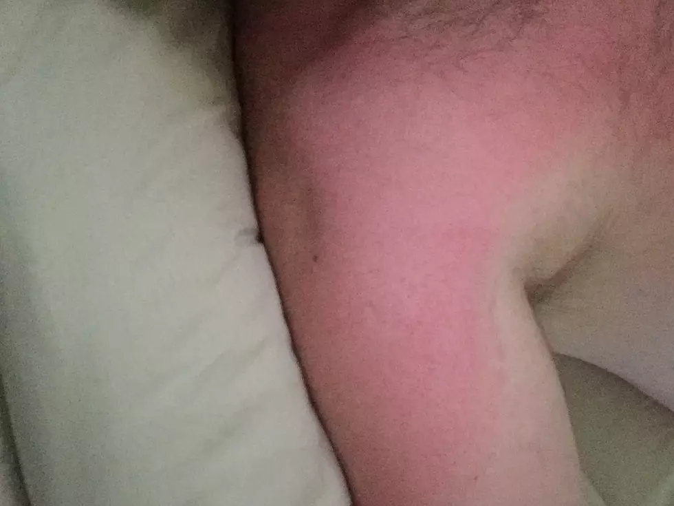 Tips For How to Handle a Bad Sunburn