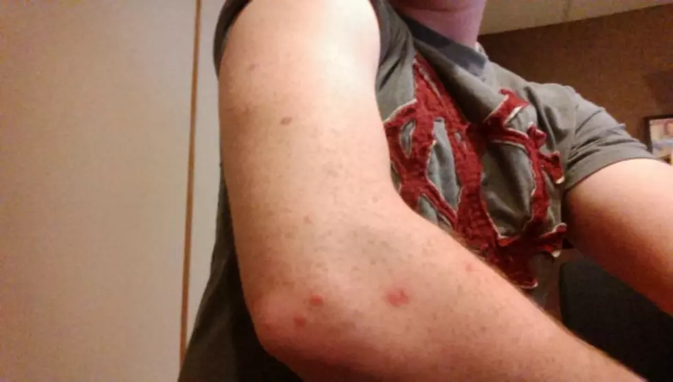 Those Are Not Chickenpox&#8211;But They Sure Itch