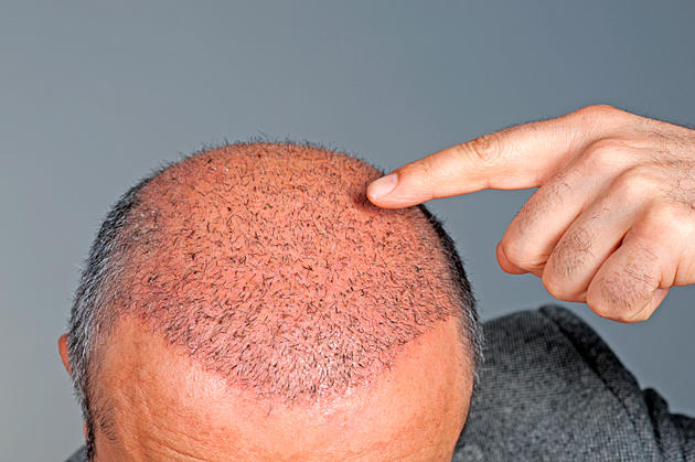 Coronavirus May Hurt Bald Men More