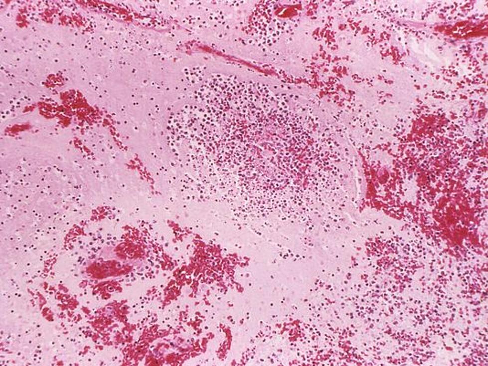 Michigan Has First Case Of Bubonic Plague