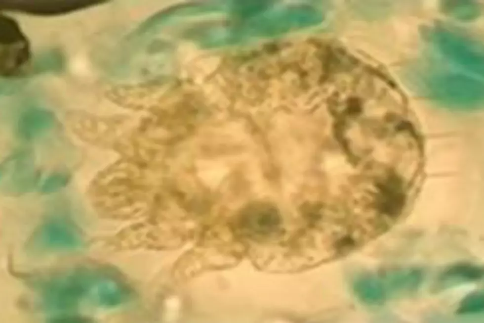 Scabies Alert In New Hampshire!