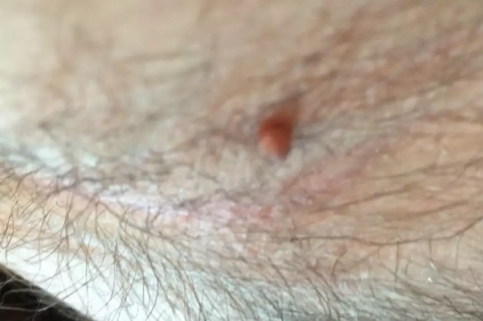 Want To Get Rid Of Those Skin Tags? [VIDEO]
