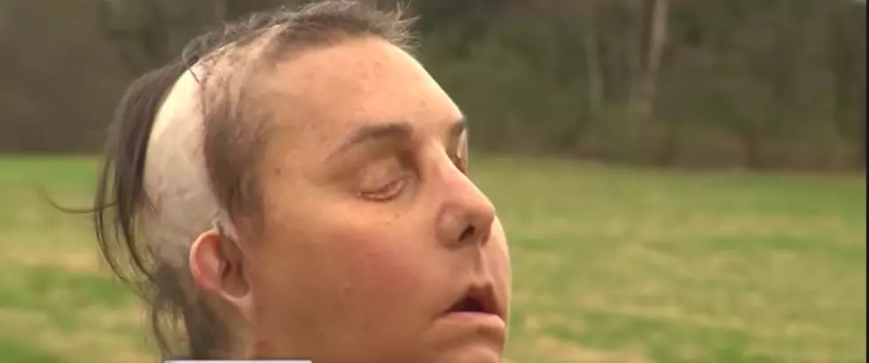 Despite all Odds, New Hampshire Woman Gets Second Face Transplant