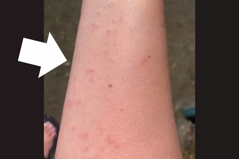 Strange Bumps Appearing Cause Panic in the Hudson Valley