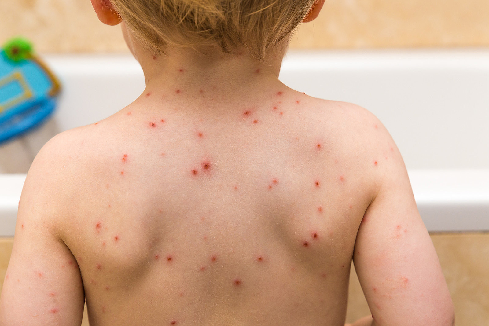 Can You Get Chickenpox Twice   RS25496 GettyImages 489634516 Scr 