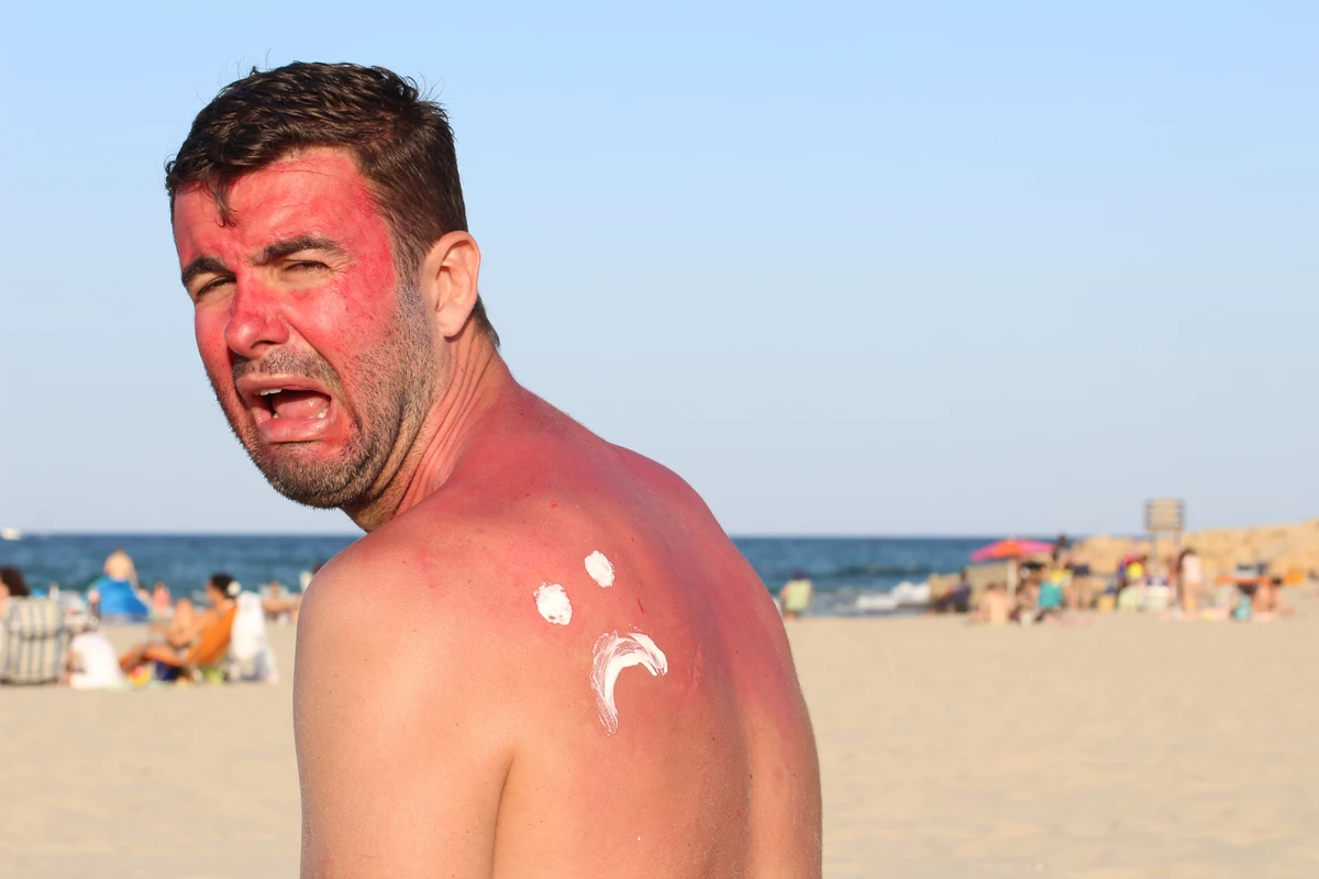 This Home Remedy Will Help Get Rid Of A Sunburn