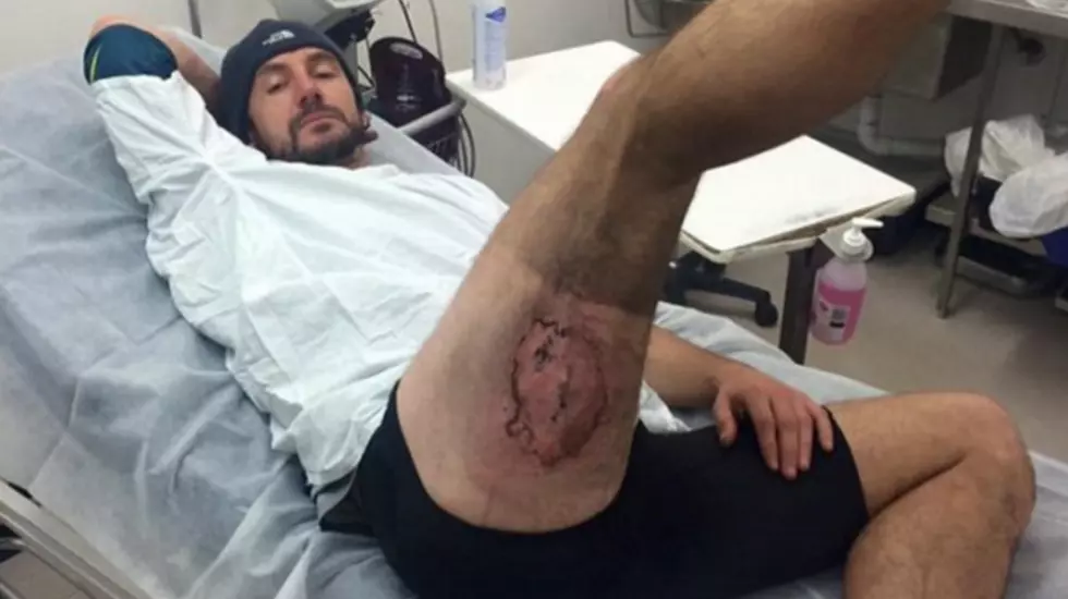 Exploding iPhone Really Burned Mountain Biker&#8217;s Ass