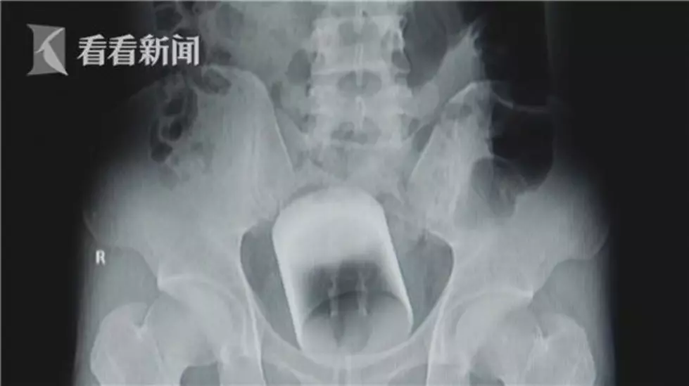 Man Gets Drinking Glass Lodged in Rectum, Won&#8217;t Tell Doctors How It Got There