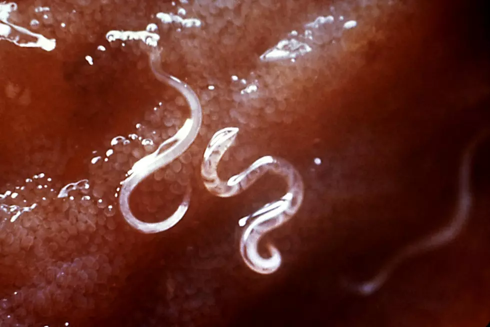 Teen Infected With Hookworms Can Feel Them Moving