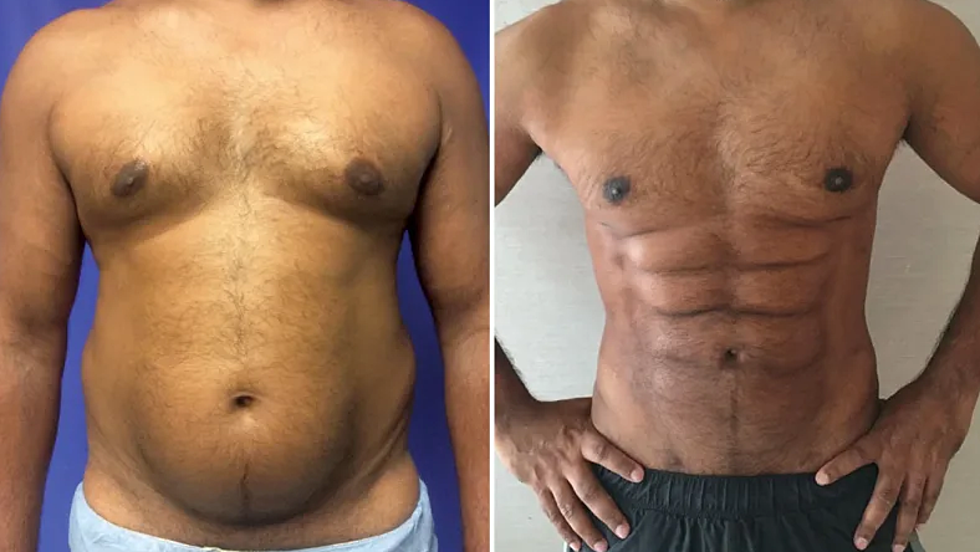 New Plastic Surgery Procedure Can Sculpt Your Belly Fat into a Six Pack