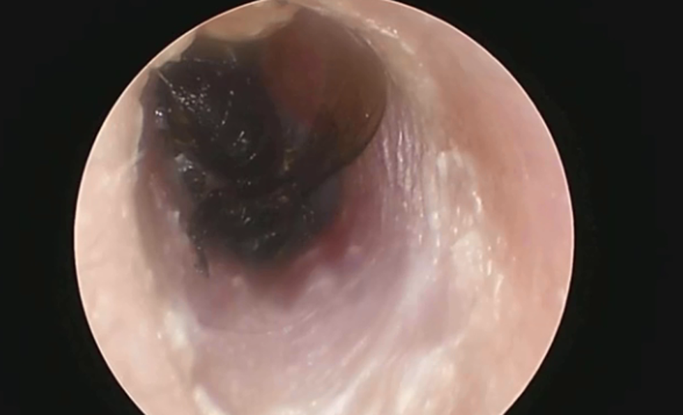 Patient Suffering Severe Ear Pain Had Bee Burrowing In Ear Canal