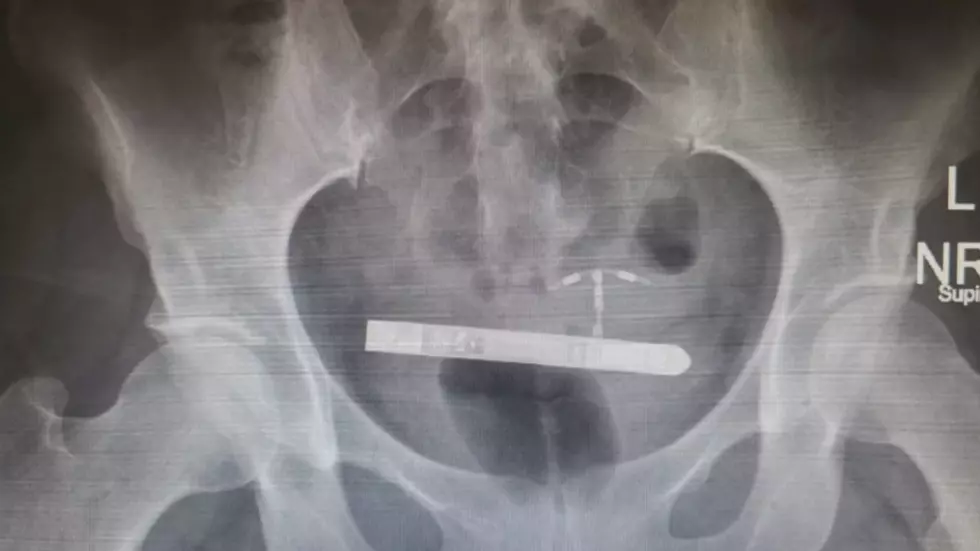 Woman Has Emergency Surgery to Remove Vibrator Stuck in Bladder