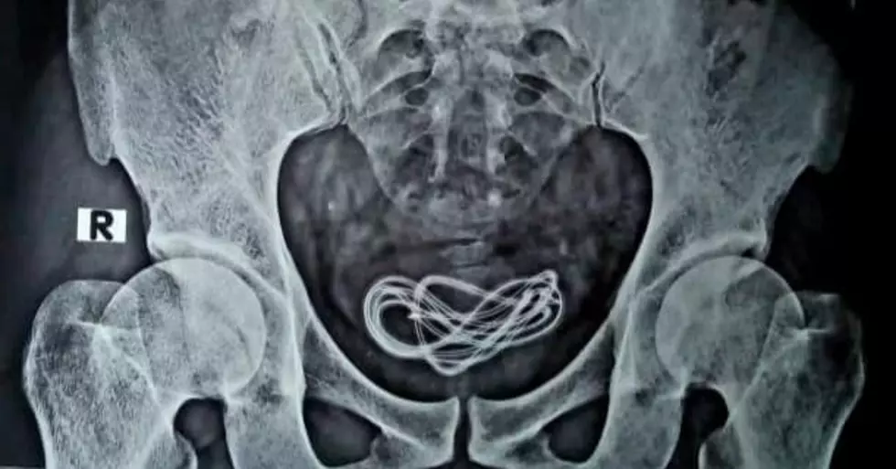 Doctors Extract Cellphone Charger from Man&#8217;s Urinary Tract