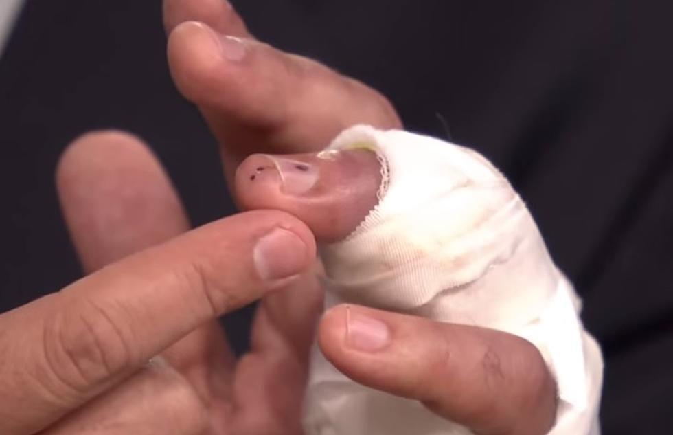 Jimmy Fallon Almost Loses Finger In Freak Accident; What&#8217;s The Weirdest Way You&#8217;ve Injured Yourself?
