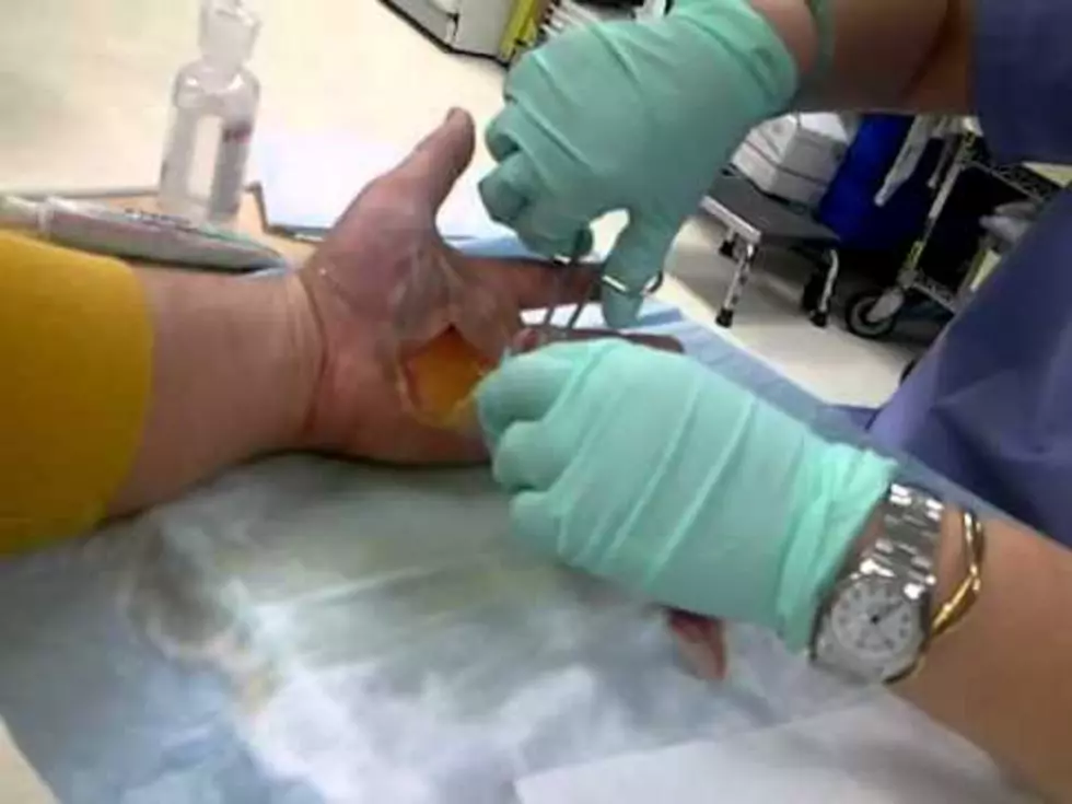 Grossest Giant Hand Blister Popping Video You’ll See Today