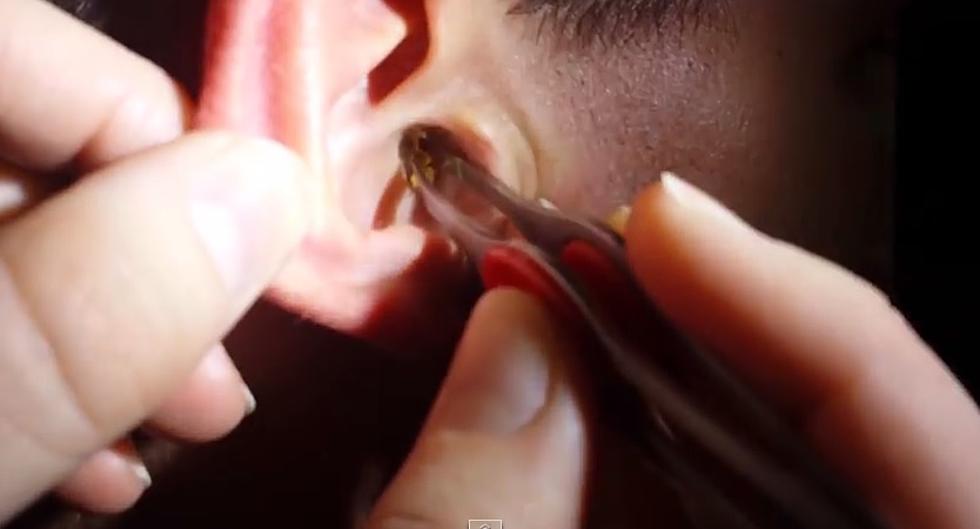 Gross Ear Wax Removal [VIDEO]