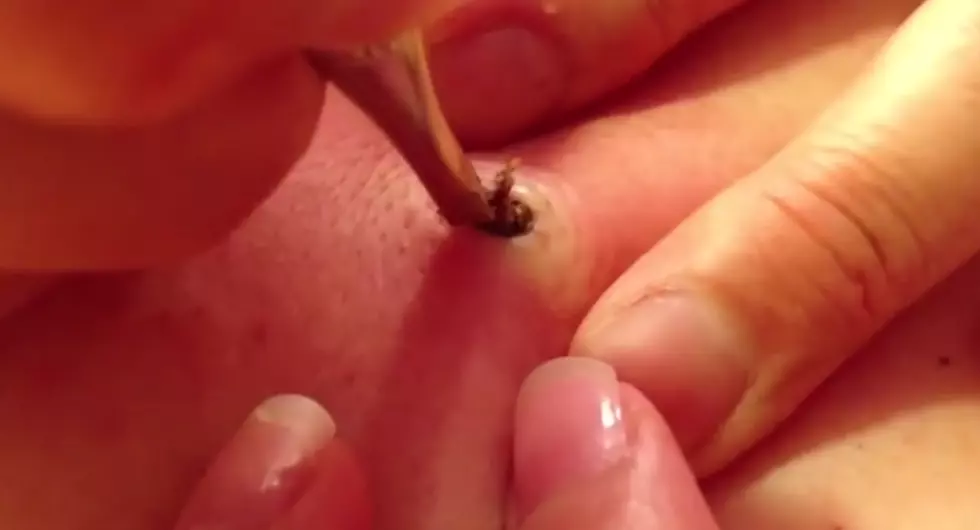 Watch This Disgusting 25-Year-Old Blackhead Get Popped [VIDEO]