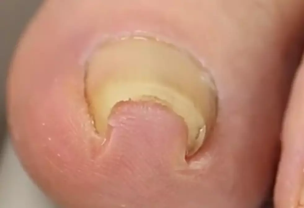 Millions of People Have Watched This Gross Ingrown Toenail Get Fixed [VIDEO]