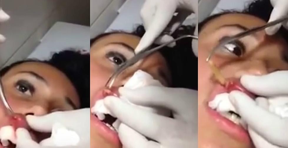 Woman Gets Worm Removed from Her Lip [VIDEOS]