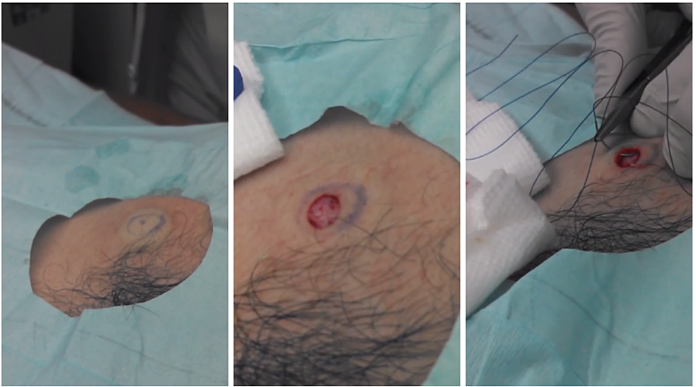 So Gross! Man’s Massive Cyst Squeezed, Leaving Gigantic Hole [VIDEO]