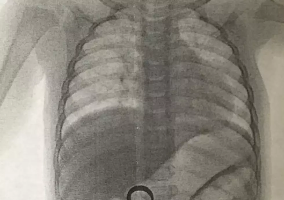 Baby Eats Wedding Ring, Parents Find It In His Stomach