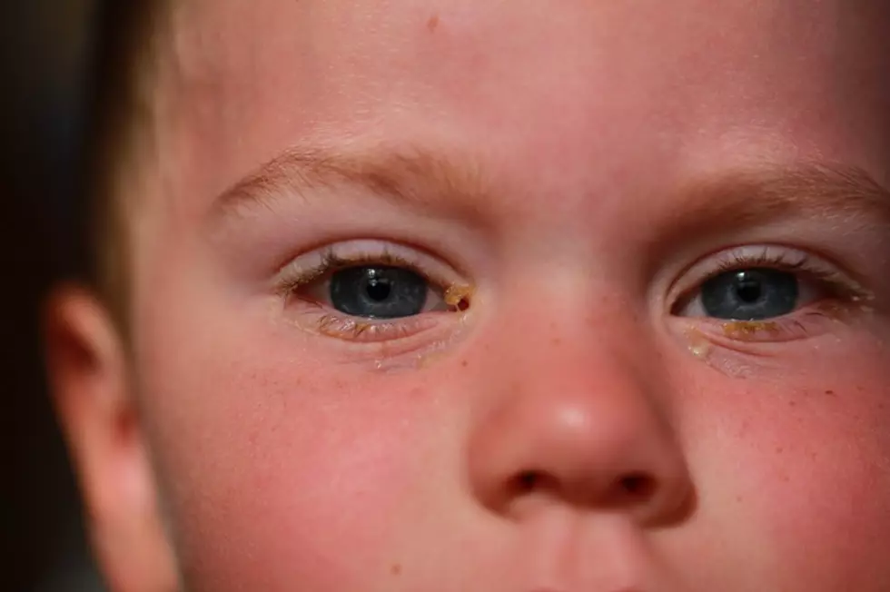 Doctors Say A Very Contagious Pink Eye &#8216;Superbug&#8217; Is Spreading